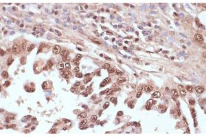 Immunohistochemistry of paraffin-embedded Human lung cancer using RAD50 Polyclonal Antibody at dilution of 1:100 (40x lens). (RAD50 Antikörper)