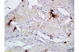 Formalin-fixed and paraffin embedded human cervical carcinoma labeled with Anti-CD72/Ly-32 Polyclonal Antibody, Unconjugated (ABIN741420) at 1:200 followed by conjugation to the secondary antibody and DAB staining (CD72 Antikörper  (AA 4-110))