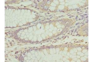 Immunohistochemistry of paraffin-embedded human colon cancer using ABIN7163515 at dilution of 1:100 (ATP2B2 Antikörper  (AA 1-80))