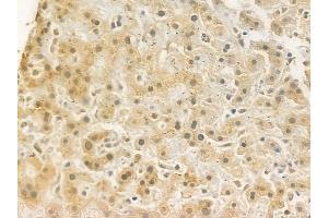 ABIN6262356 and ABIN6272323 at 1/100 staining human hepatocellular carcinoma by IHC-P.