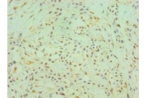 Immunohistochemistry of paraffin-embedded human breast cancer using ABIN7147014 at dilution of 1:100 (Cathepsin K Antikörper  (AA 115-329))
