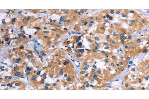 Immunohistochemistry of paraffin-embedded Human thyroid cancer using COMP Polyclonal Antibody at dilution of 1:50 (COMP Antikörper)