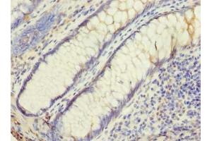 Immunohistochemistry of paraffin-embedded human colon cancer using ABIN7174455 at dilution of 1:100