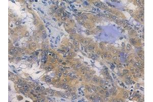 ABIN7096005 and ABIN7100067 at 1/100 staining human lung adenocarcinoma by IHC-P. (ZC4H2 Antikörper)