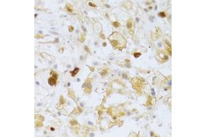 Immunohistochemistry of paraffin-embedded human brain astrocytoma using FCN1 Antibody (ABIN5973958) at dilution of 1/100 (40x lens). (FCN1 Antikörper)