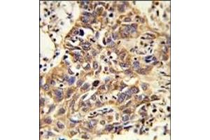 Formalin-fixed and paraffin-embedded human lung carcinoma reacted with CAT Antibody (Center), which was peroxidase-conjugated to the secondary antibody, followed by DAB staining. (Catalase Antikörper  (AA 152-180))