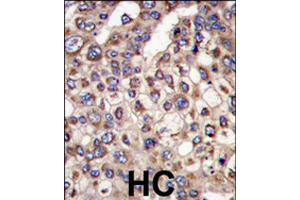 Formalin-fixed and paraffin-embedded human hepatocellular carcinoma reacted with MTMR4 polyclonal antibody  , which was peroxidase-conjugated to the secondary antibody, followed by DAB staining . (MTMR4 Antikörper  (C-Term))
