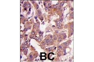 Formalin-fixed and paraffin-embedded human breast carcinoma tissue reacted with MEK1 Antibody (N-term) (ABIN1882177 and ABIN2842020) , which was peroxidase-conjugated to the secondary antibody, followed by DAB staining. (MEK1 Antikörper  (N-Term))