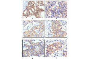 Immunohistochemical analysis of paraffin-embedded human breast intraductal carcinama tissues (A) and breast infiltrating ductal carcinama tissues (B) showing membrane localization using ERBB2 antibody with DAB staining.