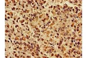 Immunohistochemistry of paraffin-embedded human glioma using ABIN7157603 at dilution of 1:100 (KIF17 Antikörper  (AA 500-777))