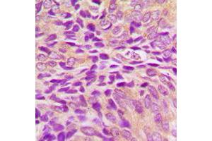 Immunohistochemical analysis of GRP75 staining in human breast cancer formalin fixed paraffin embedded tissue section. (HSPA9 Antikörper  (C-Term))