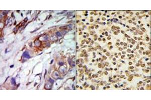 (LEFT)Formalin-fixed and paraffin-embedded human cancer tissue reacted with the primary antibody, which was peroxidase-conjugated to the secondary antibody, followed by AEC staining. (MAPK7 Antikörper  (C-Term))