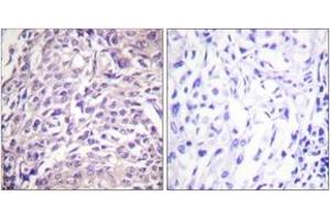 Immunohistochemistry analysis of paraffin-embedded human breast carcinoma tissue, using FOXO1A (Ab-329) Antibody. (FOXO1 Antikörper  (AA 295-344))
