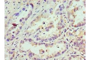 Immunohistochemistry of paraffin-embedded human lung cancer using ABIN7145712 at dilution of 1: 100 (CDCA8 Antikörper  (AA 1-280))