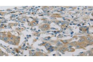 Immunohistochemistry of paraffin-embedded Human breast cancer using MAP2K6 Polyclonal Antibody at dilution of 1:30 (MAP2K6 Antikörper)