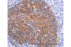 Immunohistochemistry of Human thyroid cancer using PTPN13 Polyclonal Antibody at dilution of 1:30