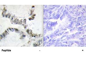 Immunohistochemistry analysis of paraffin-embedded human colon carcinoma tissue, using HMGXB3 polyclonal antibody . (HMGXB3 Antikörper)
