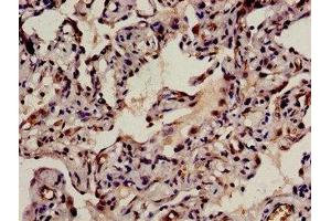 Immunohistochemistry analysis of human lung cancer using ABIN7145820 at dilution of 1:100 (BRD8 Antikörper  (AA 641-859))
