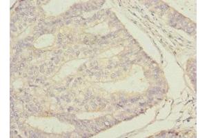 Immunohistochemistry of paraffin-embedded human endometrial cancer using ABIN7169694 at dilution of 1:100 (STAM2 Antikörper  (AA 376-525))