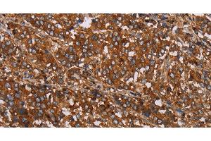 Immunohistochemistry of paraffin-embedded Human liver cancer tissue using MFAP5 Polyclonal Antibody at dilution 1:40