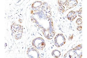 Formalin-fixed, paraffin-embedded human Breast Carcinoma stained with SM-MHC Monoclonal Antibody (SMMS-1). (MYH11 Antikörper)