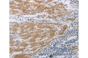 Immunohistochemistry of Human liver cancer using TNK2 Polyclonal Antibody at dilution of 1:70 (TNK2 Antikörper)