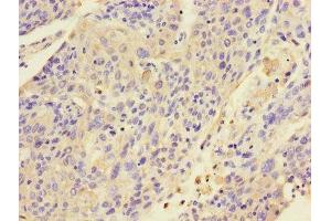 Immunohistochemistry of paraffin-embedded human cervical cancer using ABIN7157424 at dilution of 1:100 (KRT4 Antikörper  (AA 1-534))