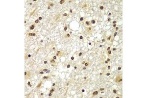 Immunohistochemistry of paraffin-embedded human brain cancer using ZNF20 antibody (ABIN5975115) at dilution of 1/100 (40x lens). (ZNF20 Antikörper)