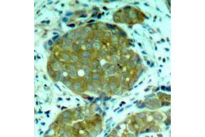 Immunohistochemistry of paraffin-embedded human breast carcinoma using Phospho-NFKB1-S932 antibody (ABIN2988211). (NFKB1 Antikörper  (pSer932))