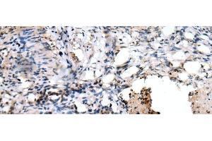 Immunohistochemistry of paraffin-embedded Human lung cancer tissue using PPP1R15A Polyclonal Antibody at dilution of 1:45(x200) (GADD34 Antikörper)