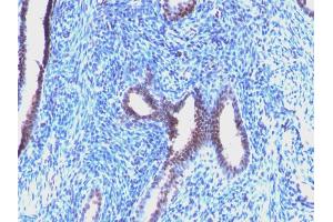 Formalin-fixed, paraffin-embedded human Endometrial Carcinoma stained with Cyclin B1 Mouse Monoclonal Antibody (CCNB1/1098).