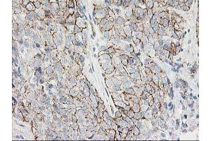 Immunohistochemical staining of paraffin-embedded Adenocarcinoma of Human breast tissue using anti-ANAPC2 mouse monoclonal antibody.