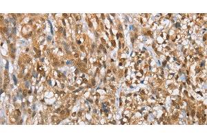 Immunohistochemistry of paraffin-embedded Human esophagus cancer tissue using MMP12 Polyclonal Antibody at dilution of 1:60 (MMP12 Antikörper)