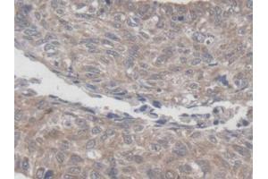 DAB staining on IHC-P; Samples: Human Lung cancer Tissue