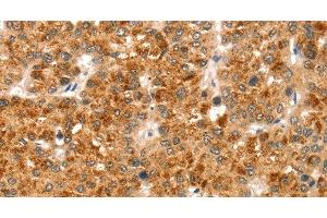 Immunohistochemistry of paraffin-embedded Human liver cancer using CCS Polyclonal Antibody at dilution of 1:35 (Superoxide dismutase copper chaperone Antikörper)