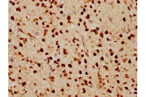 IHC image of ABIN7127502 diluted at 1:70 and staining in paraffin-embedded human glioma cancer performed on a Leica BondTM system. (Rekombinanter FTO Antikörper)