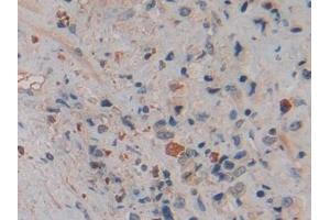 Detection of NGAL in Human Prostate cancer Tissue using Polyclonal Antibody to Neutrophil gelatinase-associated lipocalin (NGAL) (Lipocalin 2 Antikörper  (AA 21-198))