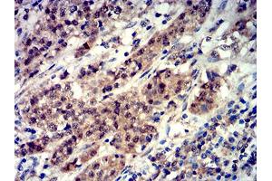 Immunohistochemical analysis of paraffin-embedded bladder cancer tissues using Phospho-4E-BP1 (Ser65) mouse mAb with DAB staining.