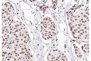 ABIN6268903 at 1/200 staining human Breast cancer tissue sections by IHC-P. (P18 INK Antikörper)