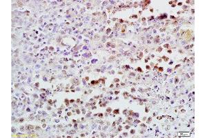 Formalin-fixed and paraffin embedded mouse lymphoma tissue labeled with Anti-CDK4 Polyclonal Antibody , Unconjugated at 1:300, followed by conjugation to the secondary antibody and DAB staining (CDK4 Antikörper  (AA 241-303))