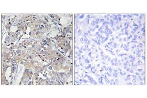 Immunohistochemistry analysis of paraffin-embedded human breast carcinoma tissue using COL6A3 antibody. (COL6a3 Antikörper  (Internal Region))