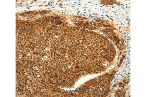 Immunohistochemistry of Human lung cancer using TRPC6 Polyclonal Antibody at dilution of 1:50 (TRPC6 Antikörper)