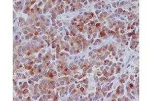 Immunohistochemical analysis of paraffin-embedded human colon cancer, using Cyclin B1 Antibody. (Rekombinanter Cyclin B1 Antikörper)