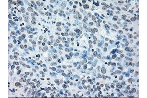 Immunohistochemical staining of paraffin-embedded Adenocarcinoma of colon tissue using anti-IRF3mouse monoclonal antibody.