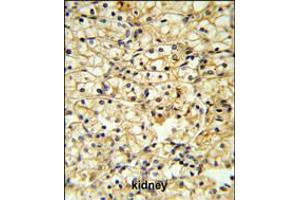 TRAP Antibody IHC analysis in formalin fixed and paraffin embedded kidney carcinoma followed by peroxidase conjugation of the secondary antibody and DAB staining. (CD40 Ligand Antikörper  (C-Term))
