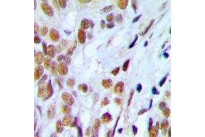 Immunohistochemical analysis of Lupus La (pS366) staining in human prostate cancer formalin fixed paraffin embedded tissue section. (Lupus La (C-Term), (pSer366) Antikörper)
