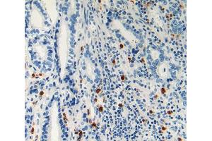 IHC-P analysis of stomach cancer tissue, with DAB staining. (LAMC2 Antikörper  (AA 416-602))