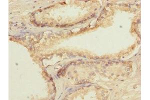 Immunohistochemistry of paraffin-embedded human prostate cancer using ABIN7172660 at dilution of 1:100