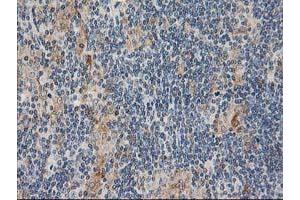 Immunohistochemical staining of paraffin-embedded Human lymphoma tissue using anti-CXorf26 mouse monoclonal antibody. (CXorf26 Antikörper)