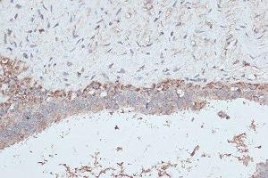 Immunohistochemistry of paraffin-embedded human breast cancer using MAP1LC3B antibody. (LC3B Antikörper)